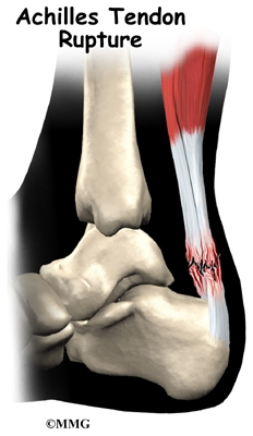 foot_achilles_tendon_intro01.jpg