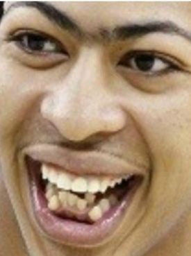 anthony-davis-teeth.jpg