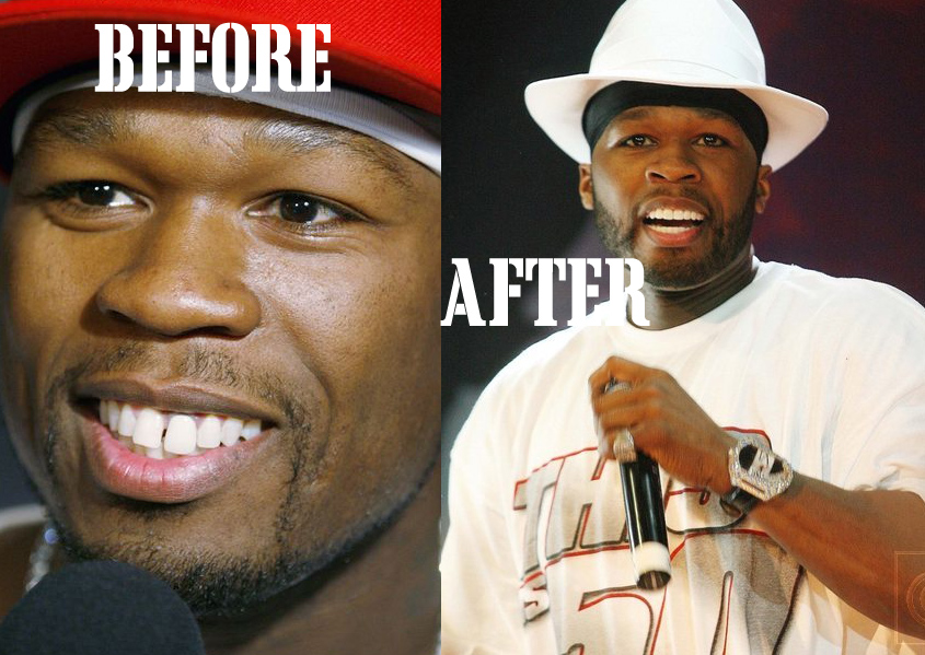 50-cent-new-teeth.jpg