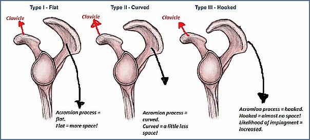 acromion_types.jpg