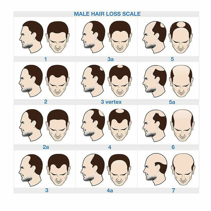 hairLossChart.jpg