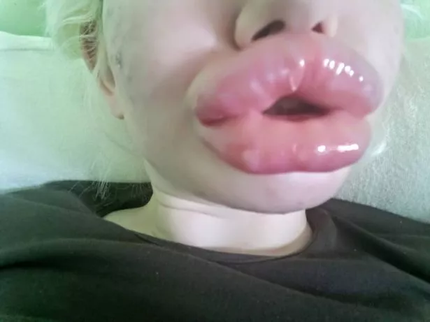 0_PAY-Woman-with-possibly-the-biggest-lips-in-the-world-shares-pics-of-her-ever-growing-pout-after-undoing.jpg