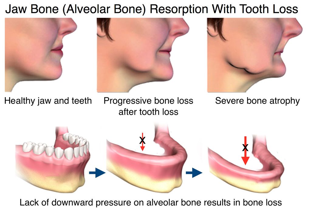 jaw-bone-loss-1024x702.jpg