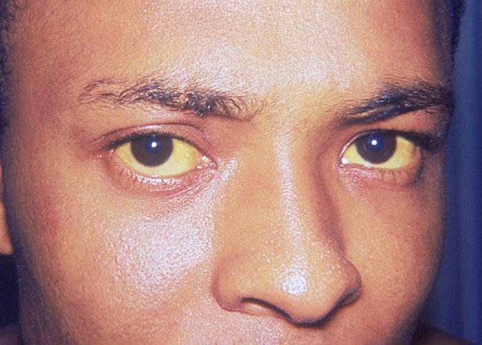 Jaundice_eye.jpg