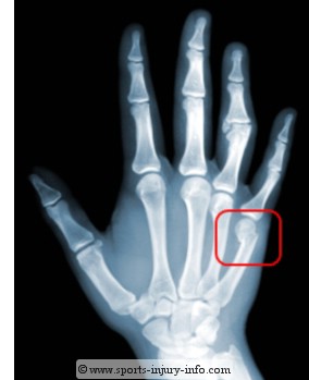 boxers-fracture.jpg