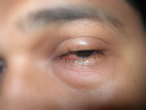 swollen-eyes.JPG