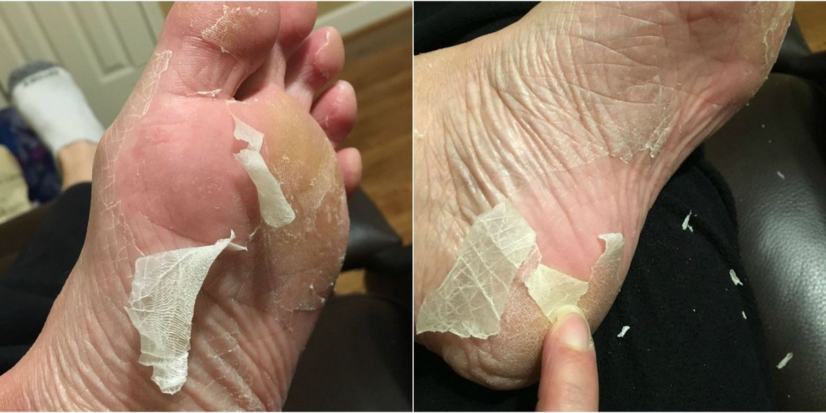 landscape-1461782423-baby-foot-peeling.jpg