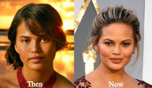 Chrissy-Teigen-Cheek-Implants-nose-job-.jpg